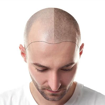 Hair Transplant in Riyadh