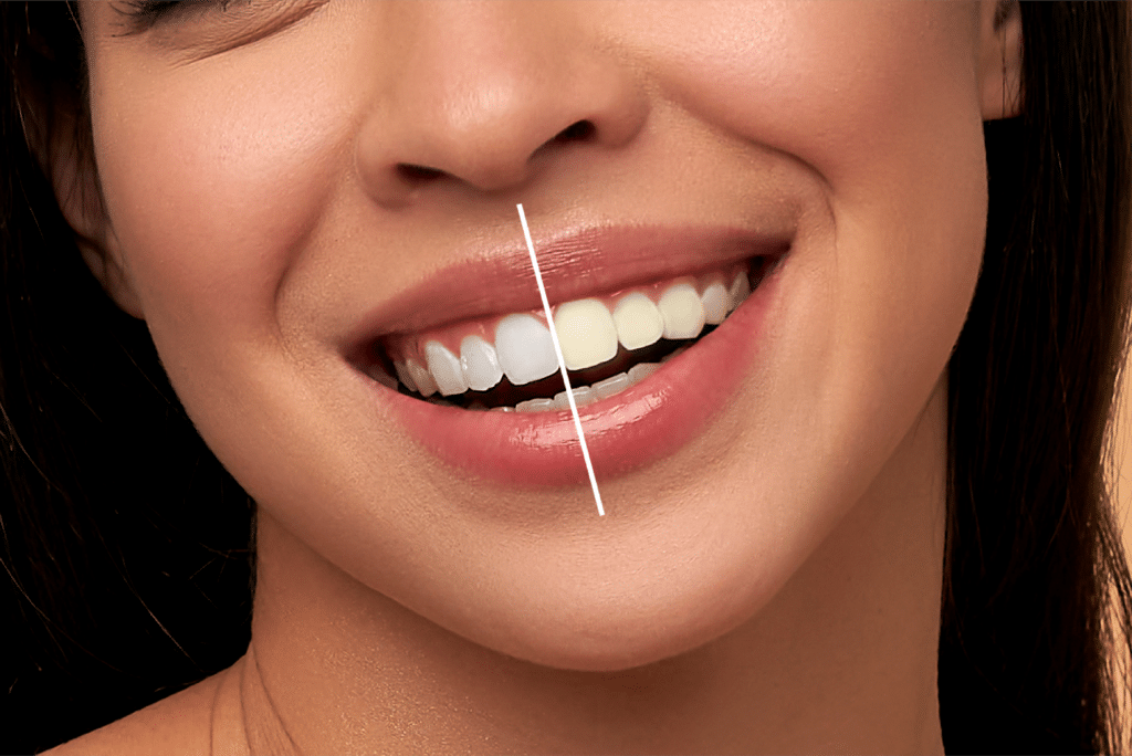 How Long Do Teeth Whitening Results Last