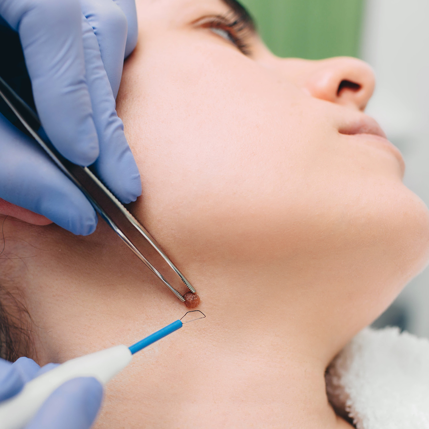 mole removal in islamabad