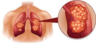 Spontaneous remission of cancer