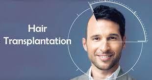 hair transplant