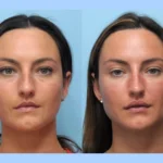 Smooth, Lift, and Define with the Best Aesthetic Clinics in Dubai for Thread Lift