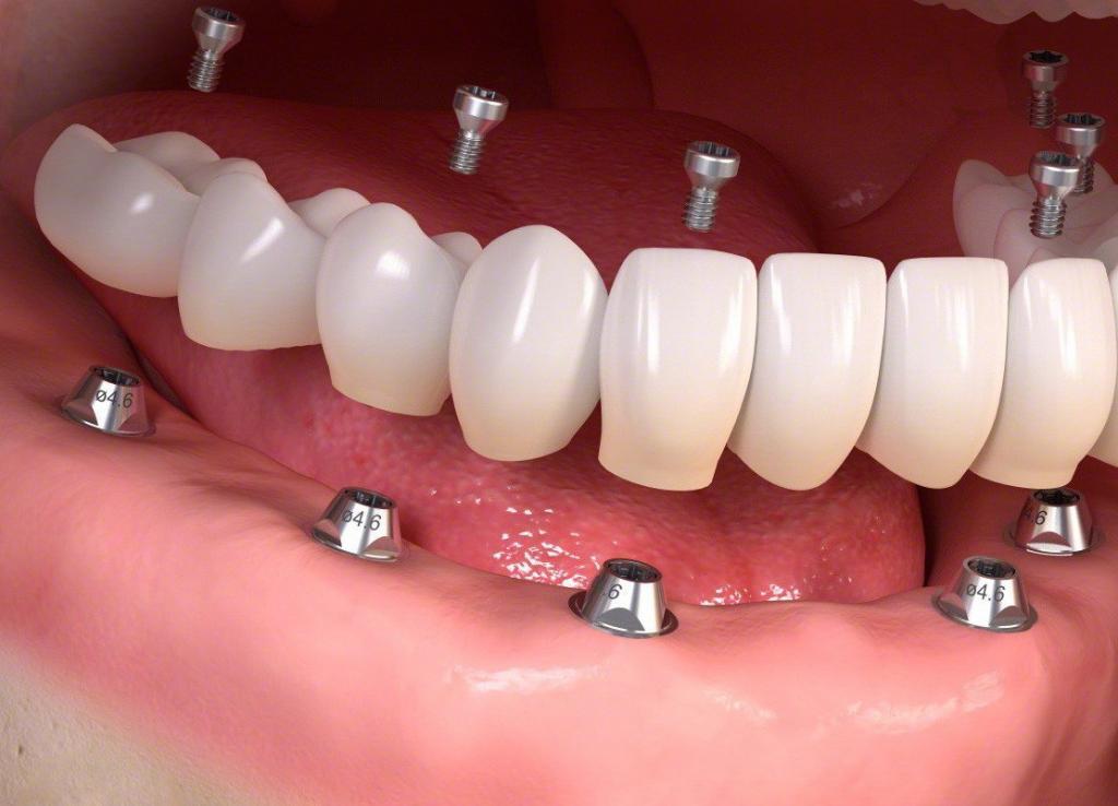 prótesis fija implantes dentales
