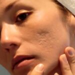 Acne Scars Treatment in Islamabad