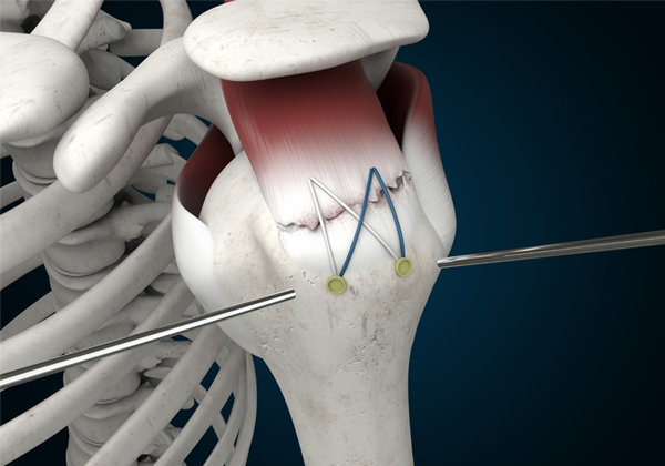 Arthroscopic-Rotator-Cuff-Repair