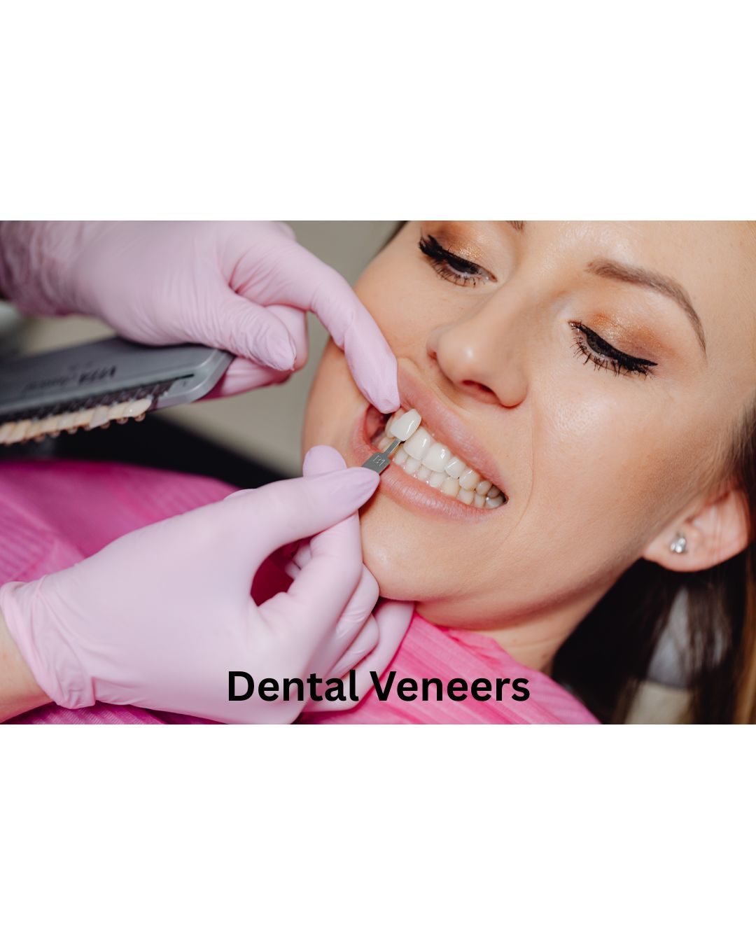 Dental Veneers