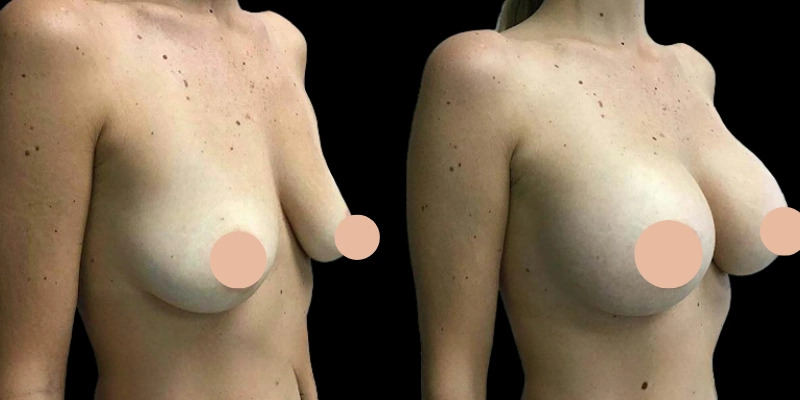 The Aesthetic Approach of the Best Breast Augmentation Surgeons in Dubai
