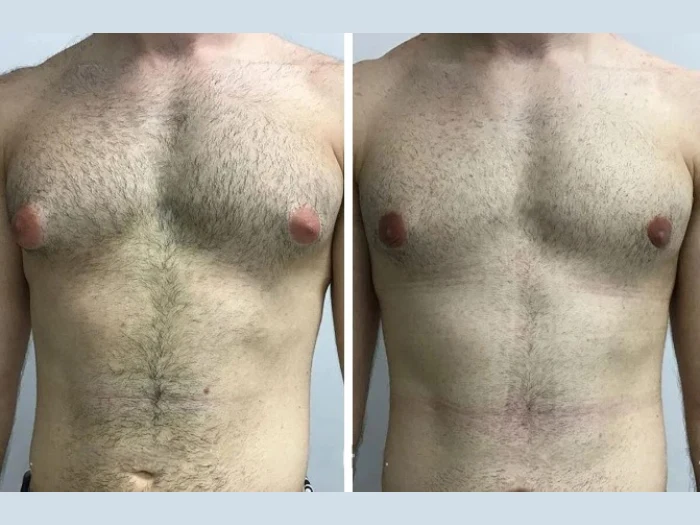How the Best Gynecomastia Surgeon in Dubai Ensures a Safe and Smooth Recovery