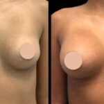 breast augmentation