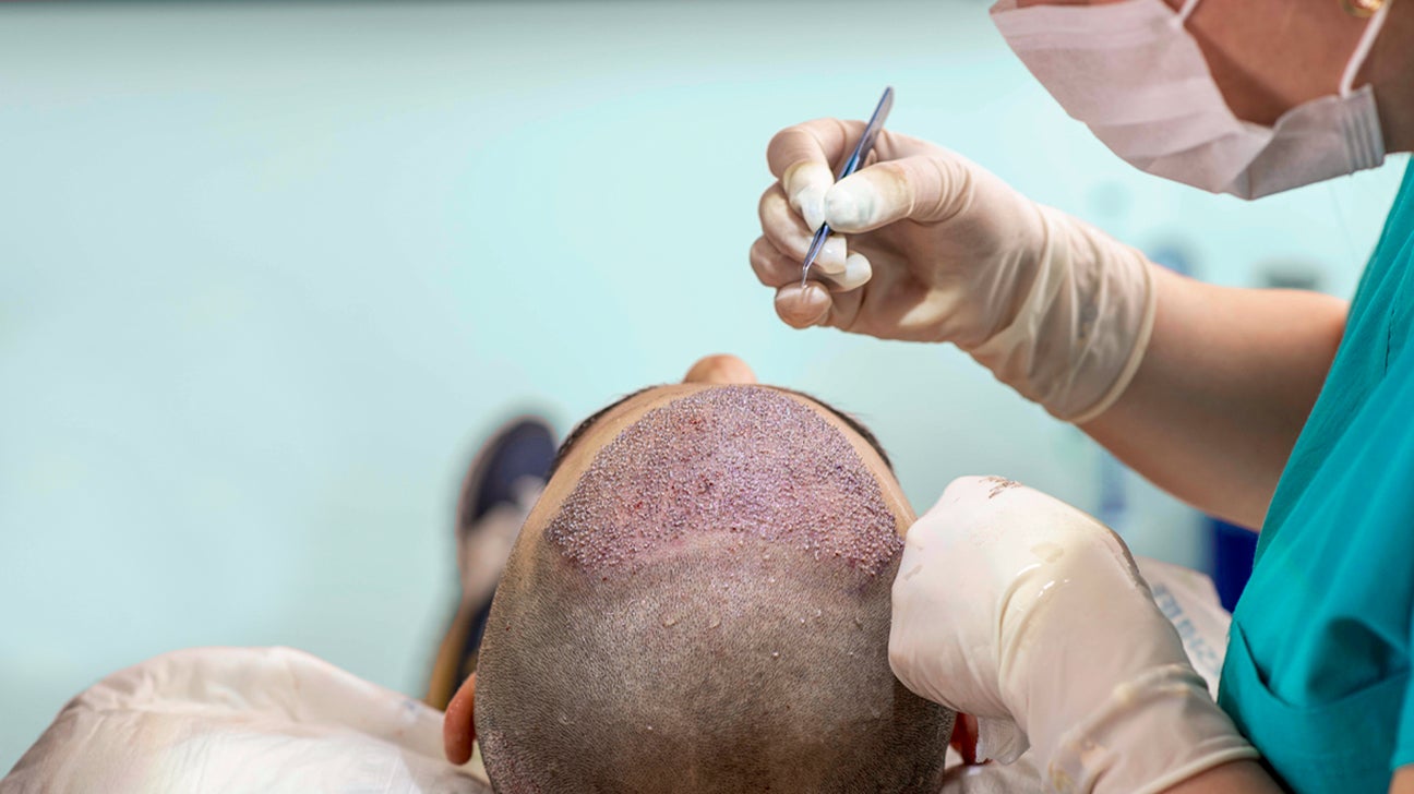 Hair Transplant in Dubai