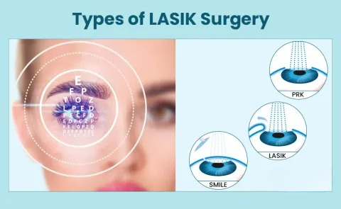 Laser Eye Surgery Methods