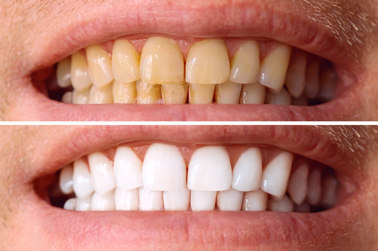 Richmond Hill teeth whitening