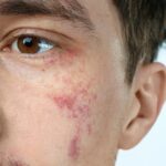 Birthmarks Removal Treatment in Dubai