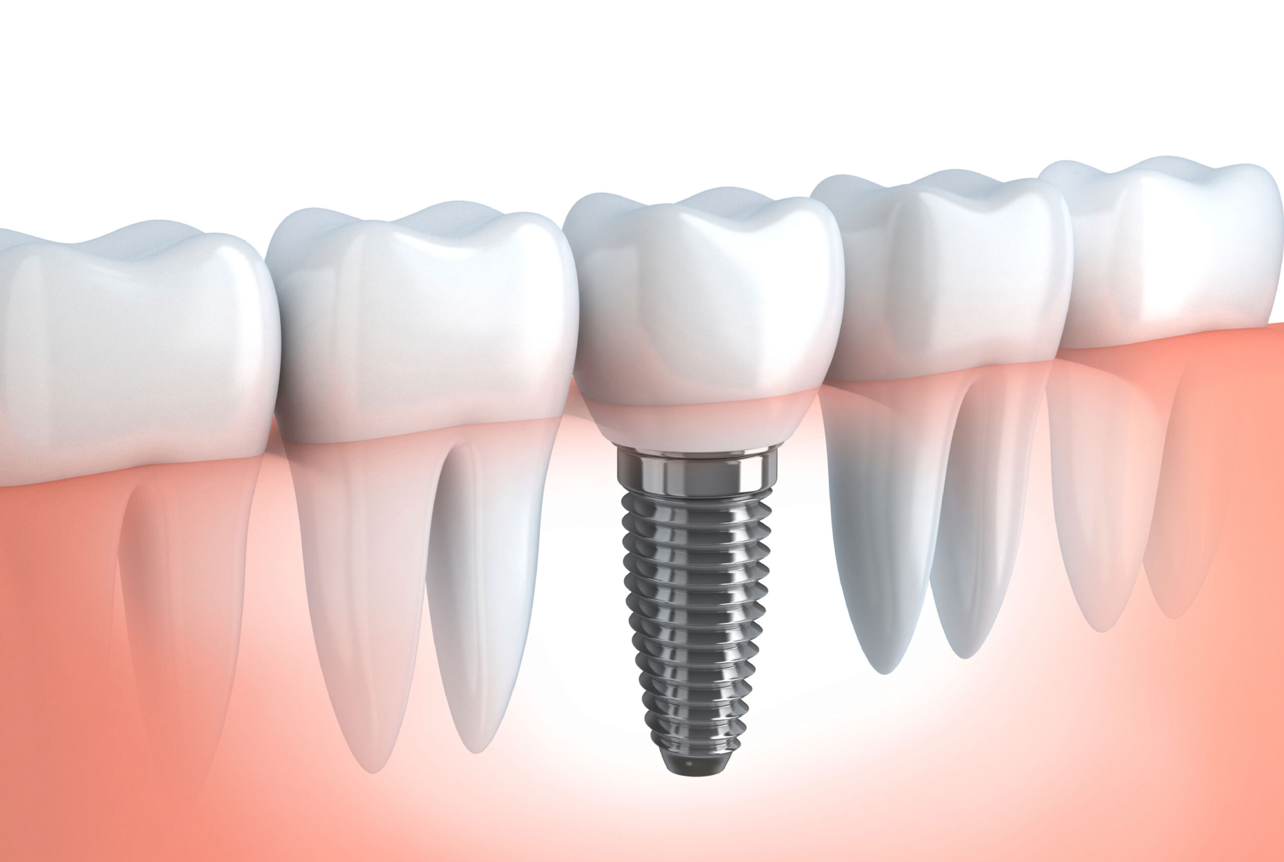 Dental Implants