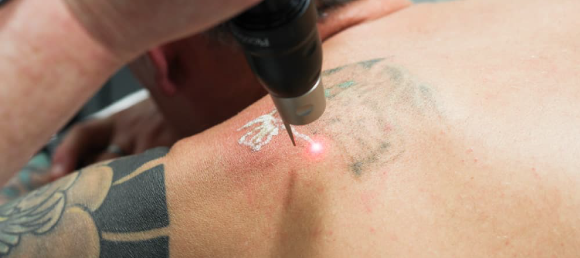 Laser Tattoo Removal in Dubai