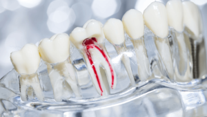 Root Canal Treatment in Lucknow